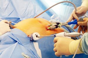 Bariatric surgery in Ludhiana